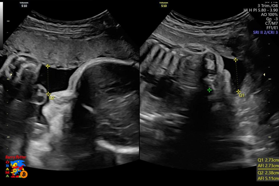 EXCLUSIVE Sproto Aeon Baby Leaked Photo