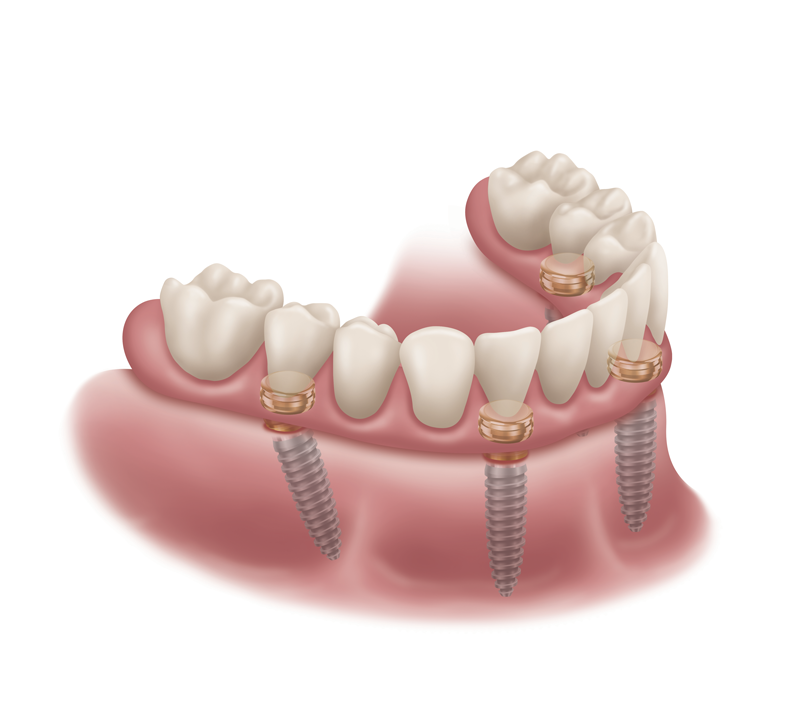 Locator Fixed Denture